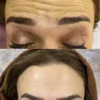 ژل بوتاکس ژل لب فیلرزیر چشم مزوتراپی مزوژل|خدمات آرایشگری و زیبایی|شیراز, کاراندیش|دیوار
