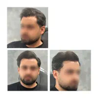 کاشت مو تبریزقیمت مناسب اقساطی فول تراکم|خدمات آرایشگری و زیبایی|صوفیان, |دیوار