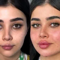بوتاکس و ژل فقط ۷۳۰