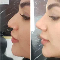 جشنواره تخفیف عمل تیپ پلاستی وبلفارو ابدو ساکشن