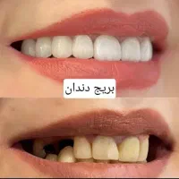 دندانسازی ناب نصف قیمت بازار|پزشکی|شیراز, حجت آباد|دیوار