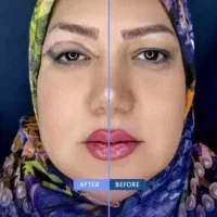 کاشت مو و ابرو ، بلفاروپلاستیک ، لیفت شقیقه و ابرو|خدمات آرایشگری و زیبایی|اهواز, نادری|دیوار