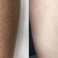 لیزر موهای زائد به صورت دائم با بهترین دستگاه لیزر|خدمات آرایشگری و زیبایی|کرمانشاه, |دیوار