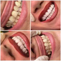دندانپزشکی/ترمیم/کامپوزیت دندان/لمینیت/عصبکشی|خدمات آرایشگری و زیبایی|تهران, تهرانپارس شرقی|دیوار