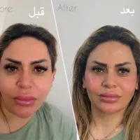 ژل بوتاکس کانتورینگ صورت آنزیم فیلر بینی مزوژل|خدمات آرایشگری و زیبایی|گرمسار, |دیوار