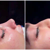 جراحی بینی لیفت سینه لیپومامو ژنیکو پیکر ابدوپروتز|خدمات آرایشگری و زیبایی|تهران, علم و صنعت|دیوار