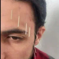 طب سوزنی،حجامت،زالو درمانی،تشخیص بیماری