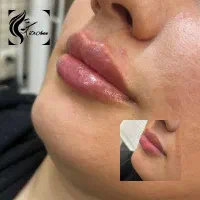 تخفیف ۲۰درصدی ژل و بوتاکس و جوانسازی