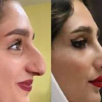 عمل بینی با دکتر حامد رستمی