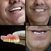 دندانسازی ،دندان مصنوعی