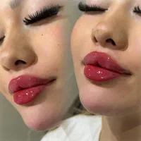 تزریق ژل (فیلر) و بوتاکس|خدمات آرایشگری و زیبایی|شیراز, عادل آباد|دیوار
