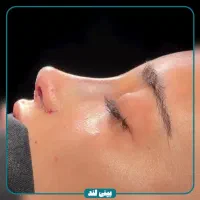 جشنواره تخفیفات جراحی بینی/عمل بینی