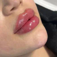 تزریق ژل لب .چانه.کات گونه.خط خنده