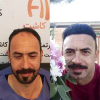 کاشت مو،کاشت ابرو،کاشت ریش با شرایط استثنایی|خدمات آرایشگری و زیبایی|تهران, دردشت|دیوار