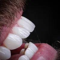 کامپوزیت دندان لمینت روکش طلا اقساط|خدمات آرایشگری و زیبایی|تهران, دریاچه شهدای خلیج فارس|دیوار