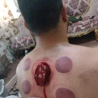 حجامت وبادکش گرم آقا وخانم