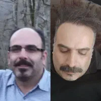 کاشت مو و ابرو تضمینی با اقساط ویژه