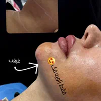 لیپوساکشن شکم و پهلو،ترنسفر به باسن،هایفودابلوگولد