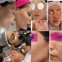 آموزش مزو نیدلینگ +تکنیک پوست کره ای+کاموفلاژ بدن