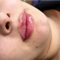 تزریق ژل و بوتاکس،فیلر بدن و لیفت با نخ|خدمات آرایشگری و زیبایی|کیش, |دیوار