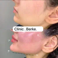 اخرین ورژن دستگاه هایفوتراپی هایفو لومینوس