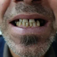 دندان مصنوعی با قیمت اقتصادی و تحویل سریع|پزشکی|رشت, معلولین|دیوار