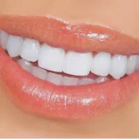 کامپوزیت، ارتودنسی اقساط بدون‌سود