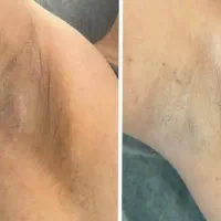 روشن سازی نواحی تیره بدن و صورت(مایابیوتی)
