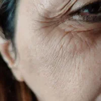 مشاوره پوست رفع قطعی چین و چروک صورت