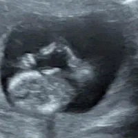 خانم مجرد تایپیست برای سونوگرافی