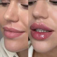 تخفیف ویژه لیفت صورت با نخ لیفت و کلاژن|خدمات زیبایی و سلامت|تهران, توحید|دیوار