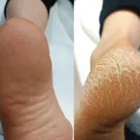 تخفیف کفسابی تخصصی پا(VIP)