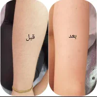 لیزرموهای زائد ویژه بانوان|خدمات آرایشگری و زیبایی|مشهد, توس (بلوار توس)|دیوار