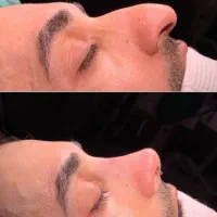 جشنواره جراحی و عمل بینی/پیکرتراشی/لیفت|خدمات زیبایی و سلامت|کرج, عظیمیه|دیوار
