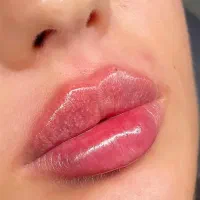 پکیج صورت مدلینگ و بوتاکس و مزوتراپی