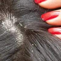 درمان رشک و شپش