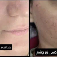 خدمات لیزر پوست زیبایی