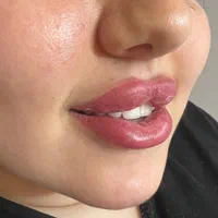 ژل بوتاکس فیلر مزو نخ کانتورینگ‌ درکلینیک زیبایی|خدمات آرایشگری و زیبایی|تبریز, |دیوار