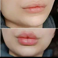 آموزش وتزریق،ژل،بوتاکس،مزوژل زیرچشم،آنزیم ومزو|خدمات آرایشگری و زیبایی|کرج, فاز ۳ گوهردشت|دیوار