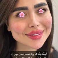 ژل لب گونه چونه زاویه فک خط خنده بوتاکس فقط ۲۹۰|خدمات آرایشگری و زیبایی|قم, سالاریه|دیوار