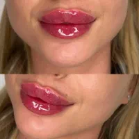 تزریق فیلر،ژل،بوتاکس|خدمات آرایشگری و زیبایی|کرمانشاه, |دیوار