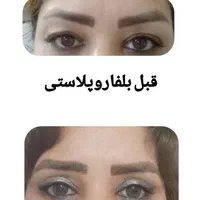 جشنواره بلفاروپلاستی با بخیه لیزری،لیفت شقیقه و..|خدمات آرایشگری و زیبایی|مشهد, کوه سنگی|دیوار