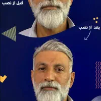 کاشت مو‌بدون جراحی  (پروتز مو‌بدون‌چسب)|خدمات آرایشگری و زیبایی|درگهان, |دیوار