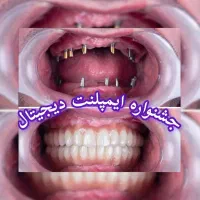 3 واحد ایمپلنت1واحد رایگان/جشنواره ایمپلنت دیجیتال