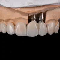 استخدام کاراموز پسر برای دندانسازی