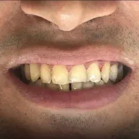 کامپوزیت دندان