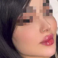 آف ژل لب کره‌ای فول‌فیس بوتاکس چال گونه پیرسینک