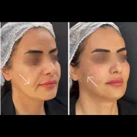 لیفت BAU فیس لیفت صورت اصلاح افتادگی لاغری صورت|خدمات آرایشگری و زیبایی|مشهد, هفت تیر (حافظ)|دیوار