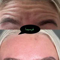جشنواره تابستانه بوتاکس خال لاغری مزو‌ موفرسیما|خدمات آرایشگری و زیبایی|همدان, |دیوار