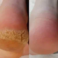 پدیکور پا با یه تخفیف ویژه